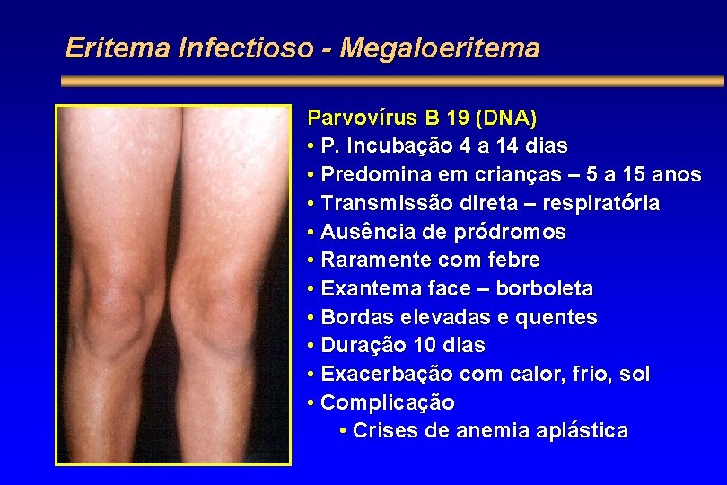 Eritema Infectioso - Megaloeritema Parvovírus B 19 (DNA) • P. Incubação 4 a 14