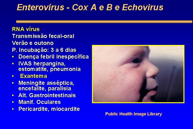 Enterovírus - Cox A e B e Echovirus RNA vírus Transmissão fecal-oral Verão e