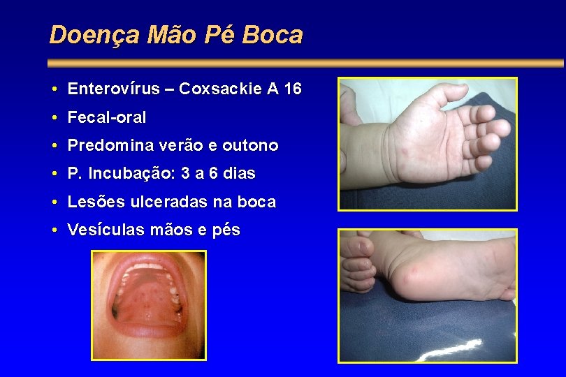Doença Mão Pé Boca • Enterovírus – Coxsackie A 16 • Fecal-oral • Predomina