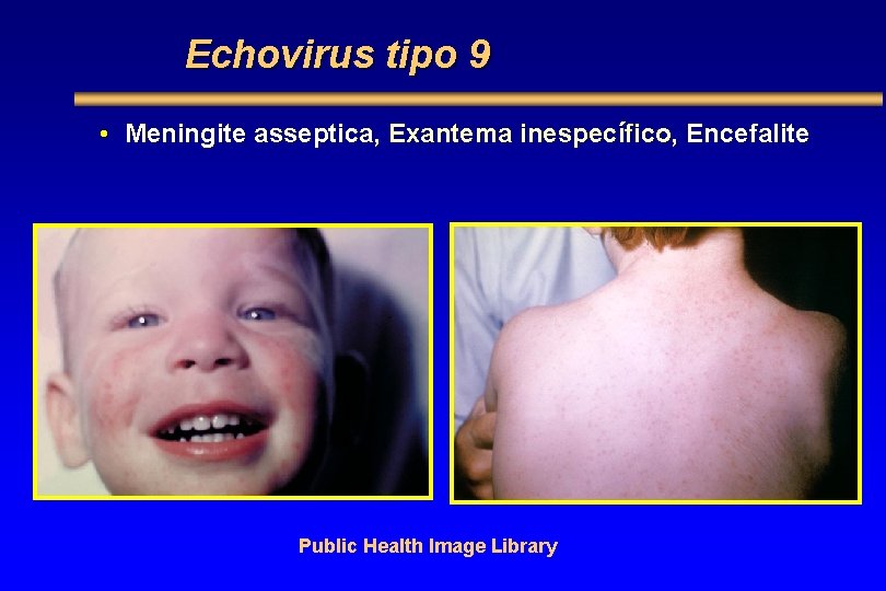 Echovirus tipo 9 • Meningite asseptica, Exantema inespecífico, Encefalite Public Health Image Library 