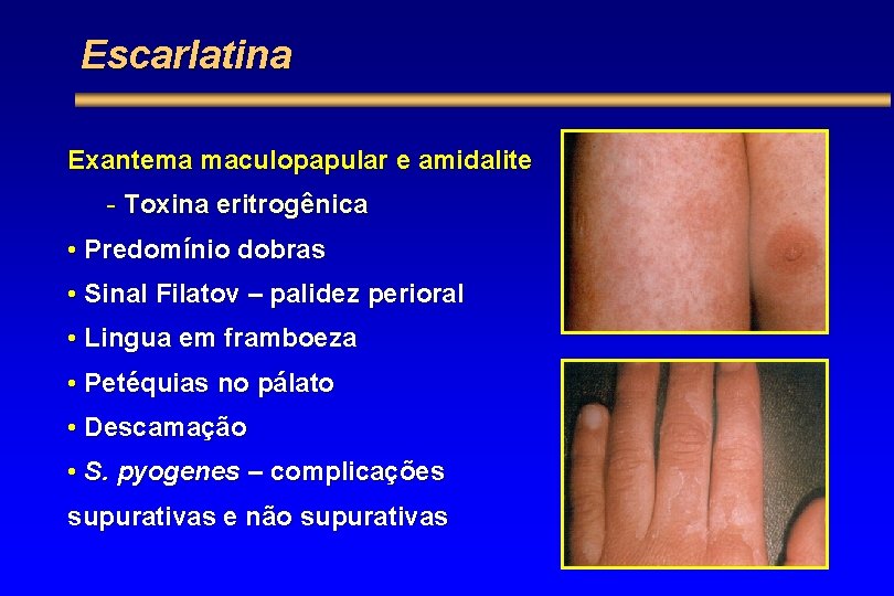Escarlatina Exantema maculopapular e amidalite - Toxina eritrogênica • Predomínio dobras • Sinal Filatov