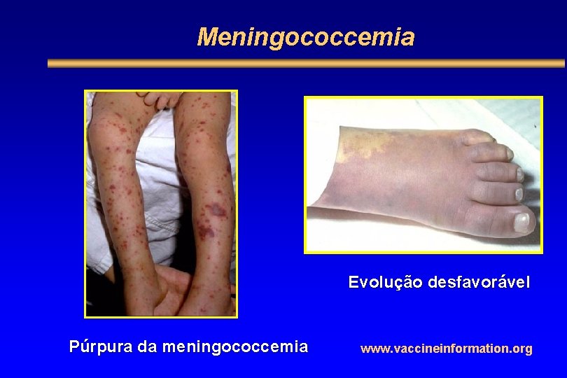 Meningococcemia Evolução desfavorável Púrpura da meningococcemia www. vaccineinformation. org 