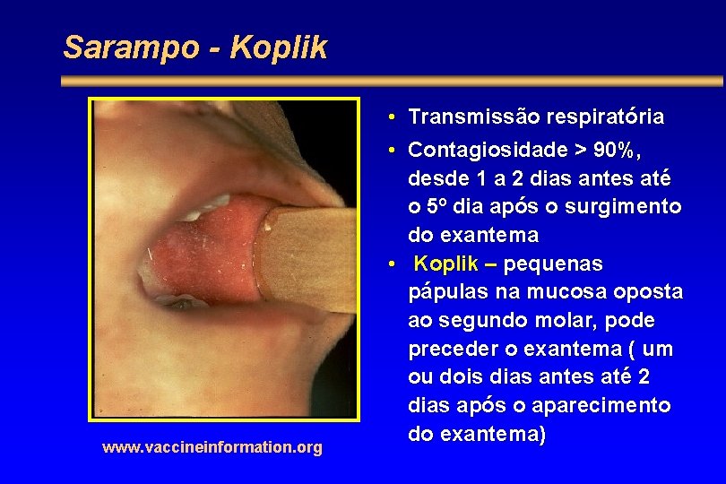Sarampo - Koplik www. vaccineinformation. org • Transmissão respiratória • Contagiosidade > 90%, desde