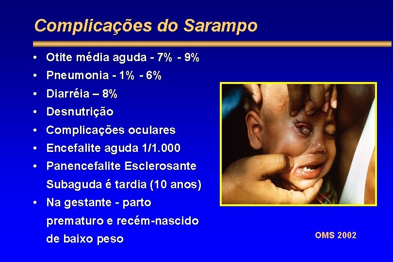 Complicações do Sarampo • Otite média aguda - 7% - 9% • Pneumonia -