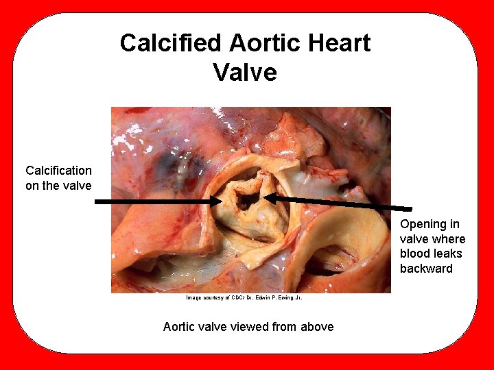 Calcified Aortic Heart Valve Calcification on the valve Opening in valve where blood leaks