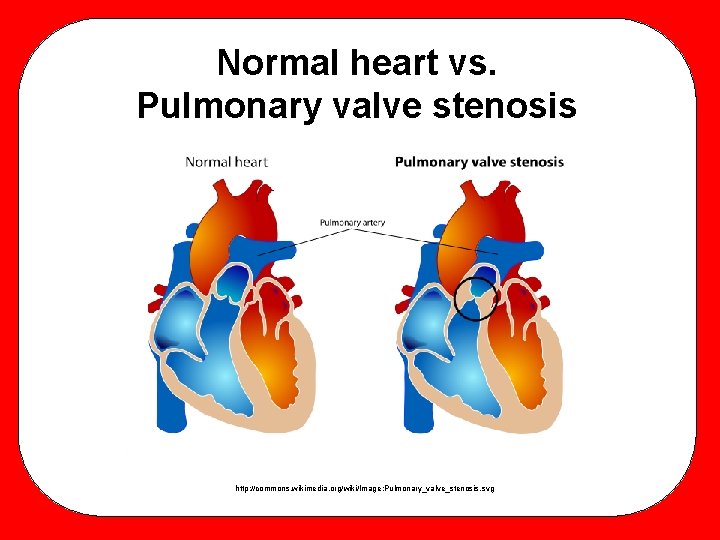 Normal heart vs. Pulmonary valve stenosis http: //commons. wikimedia. org/wiki/Image: Pulmonary_valve_stenosis. svg 