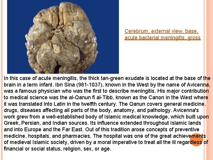 Cerebrum, external view, base, acute bacterial meningitis, gross In this case of acute meningitis,