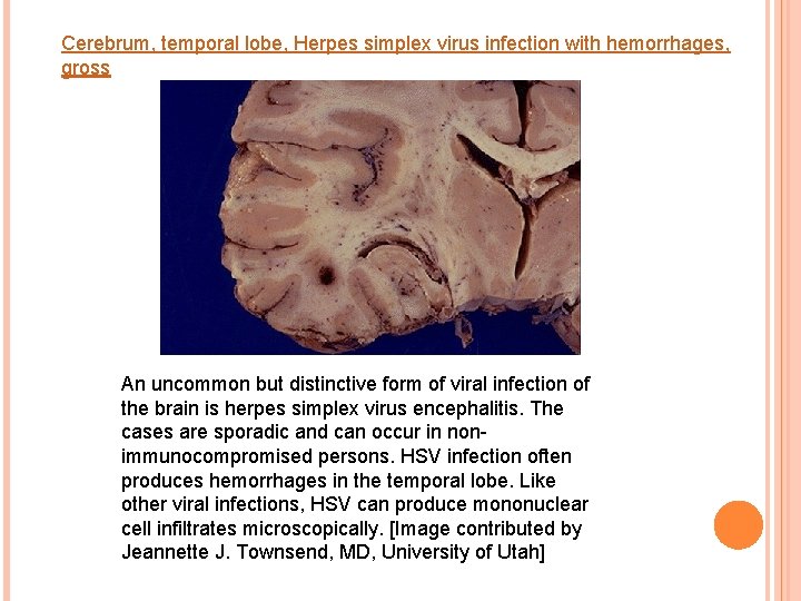 Cerebrum, temporal lobe, Herpes simplex virus infection with hemorrhages, gross An uncommon but distinctive
