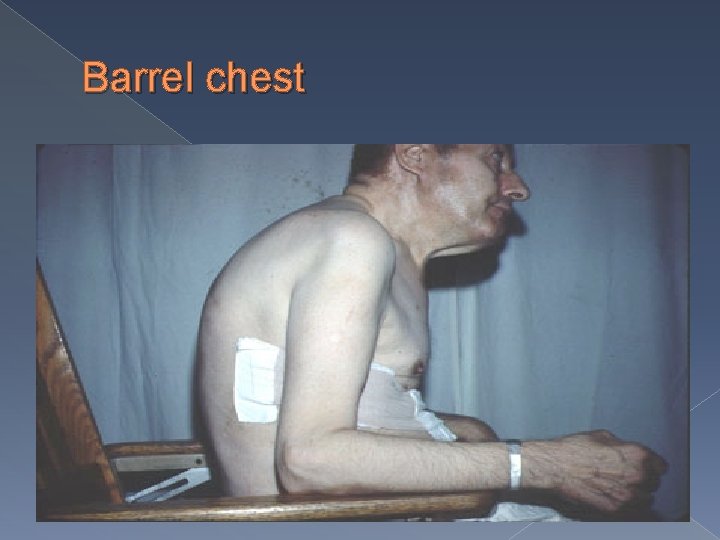 Barrel chest 