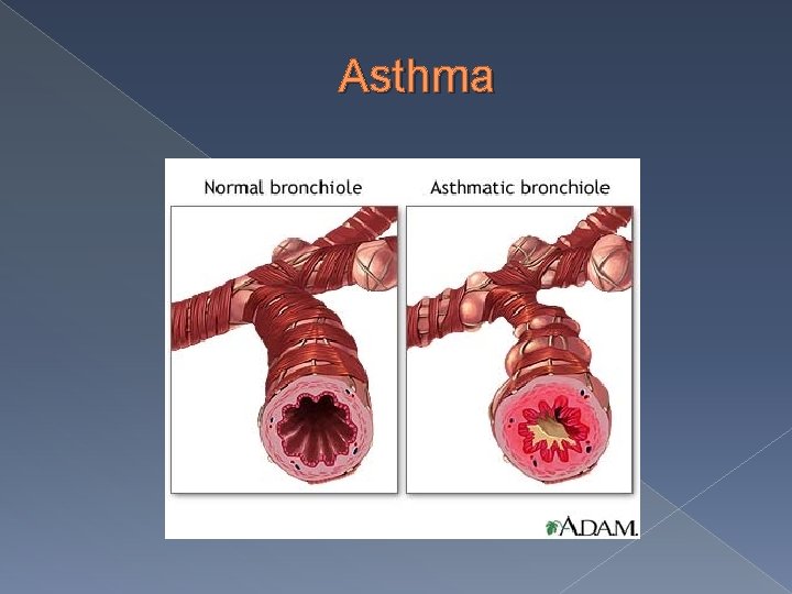 Asthma 