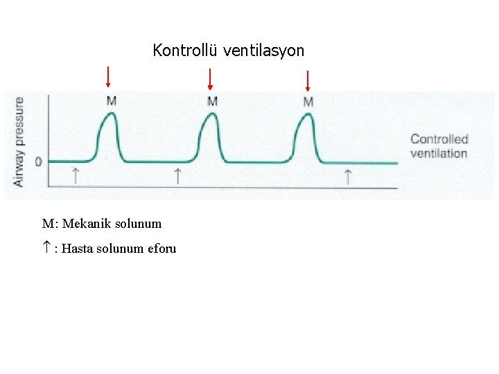 Kontrollü ventilasyon M: Mekanik solunum : Hasta solunum eforu 