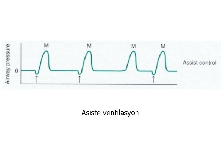 Asiste ventilasyon 