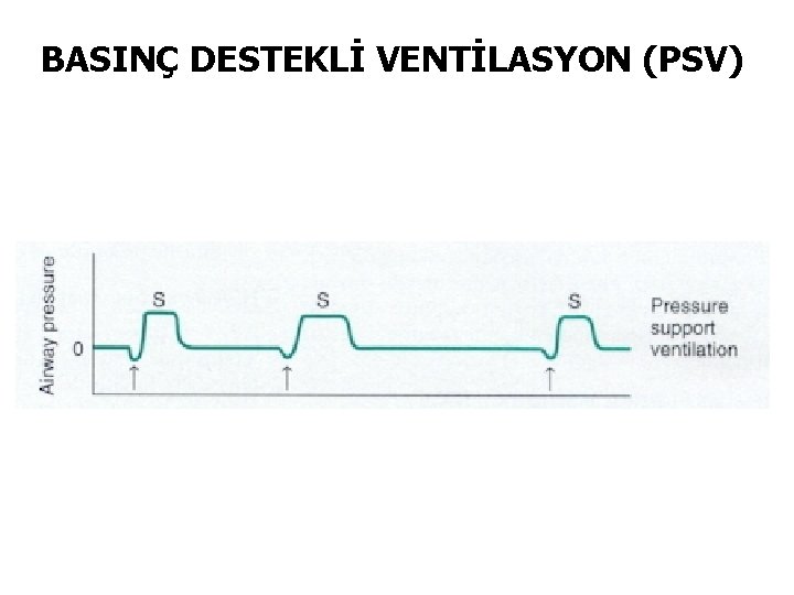 BASINÇ DESTEKLİ VENTİLASYON (PSV) 