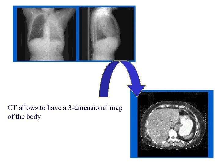 CT allows to have a 3 -dmensional map of the body 