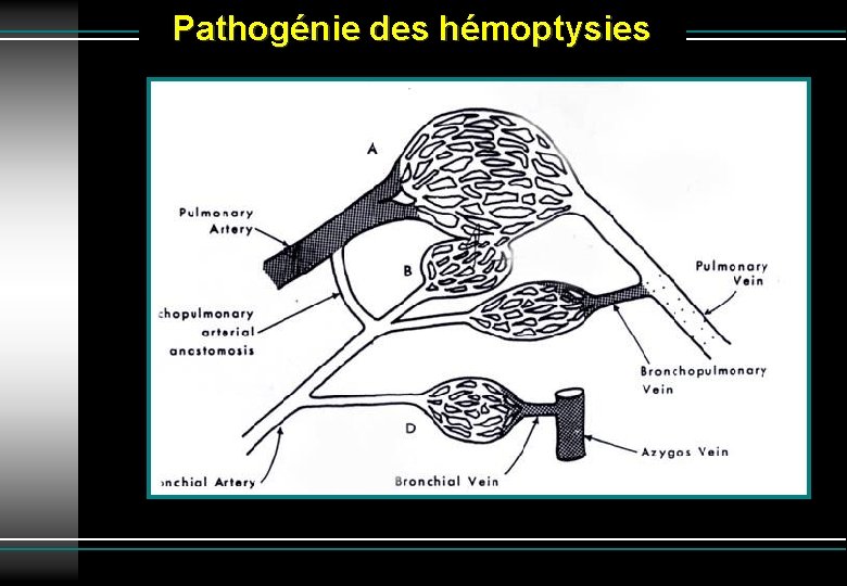 Pathogénie des hémoptysies 