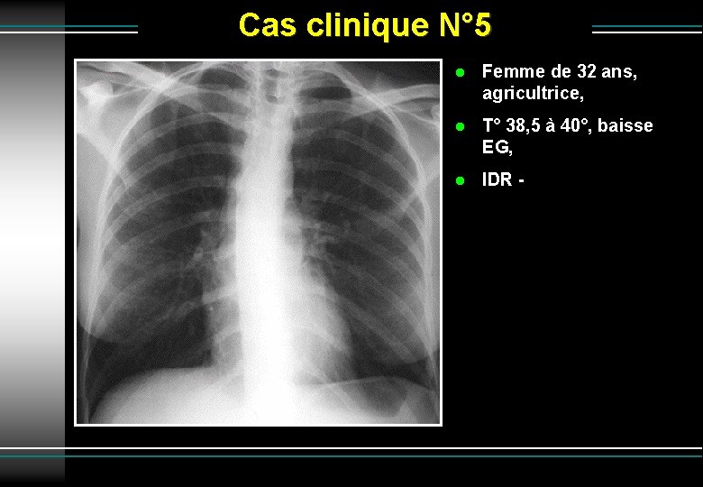 Cas clinique N° 5 Femme de 32 ans, agricultrice, T° 38, 5 à 40°,