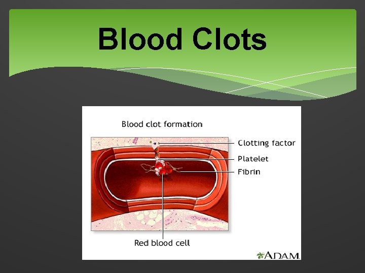 Blood Clots 