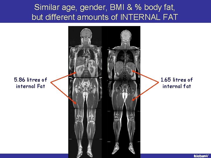 Similar age, gender, BMI & % body fat, but different amounts of INTERNAL FAT