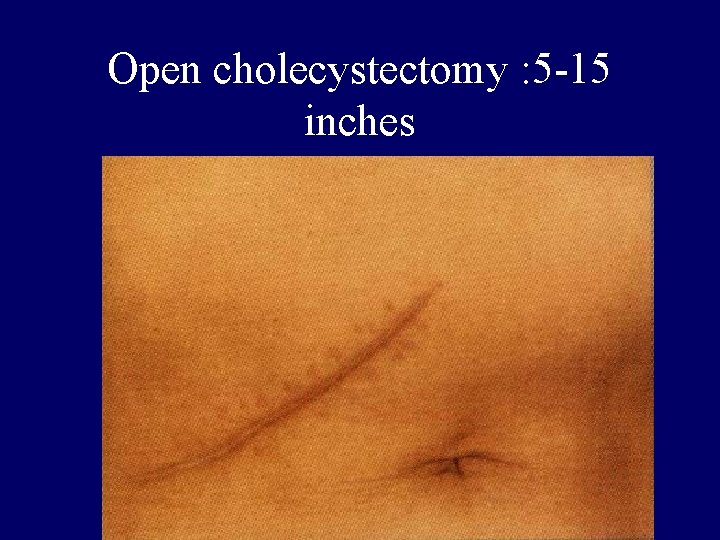 Open cholecystectomy : 5 -15 inches 