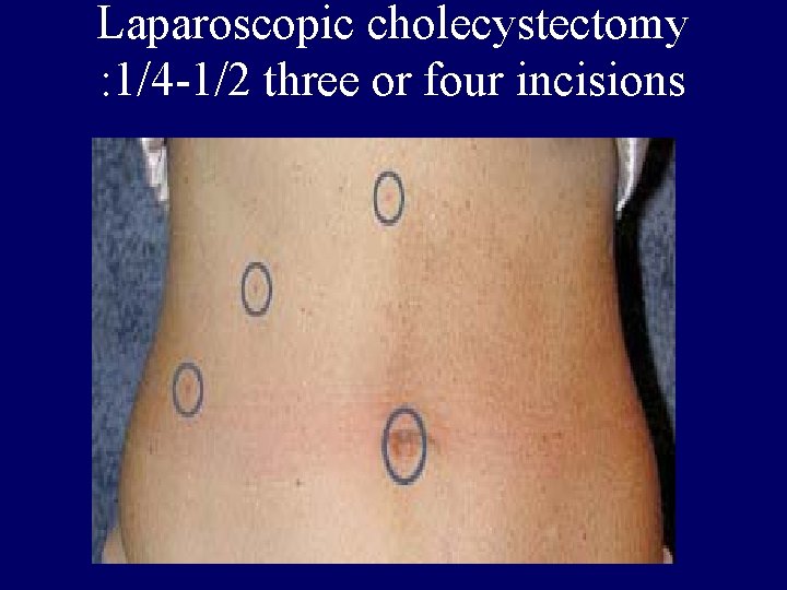 Laparoscopic cholecystectomy : 1/4 -1/2 three or four incisions 