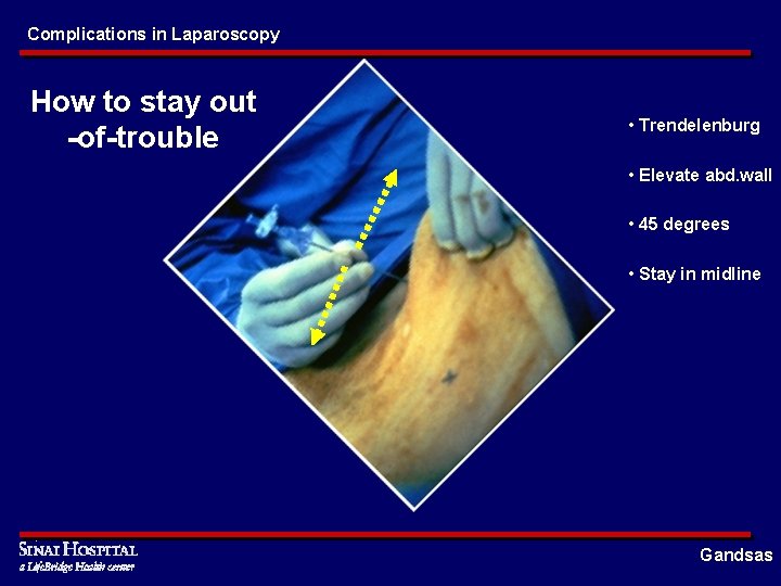 Complications in Laparoscopy How to stay out -of-trouble • Trendelenburg • Elevate abd. wall