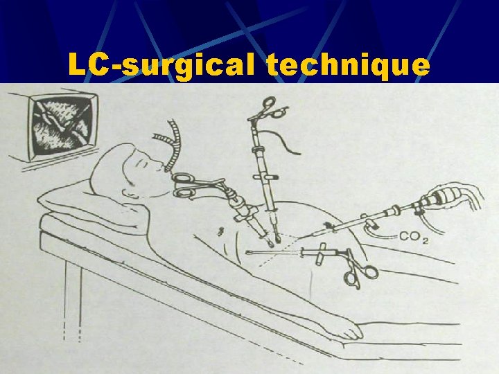 LC-surgical technique 