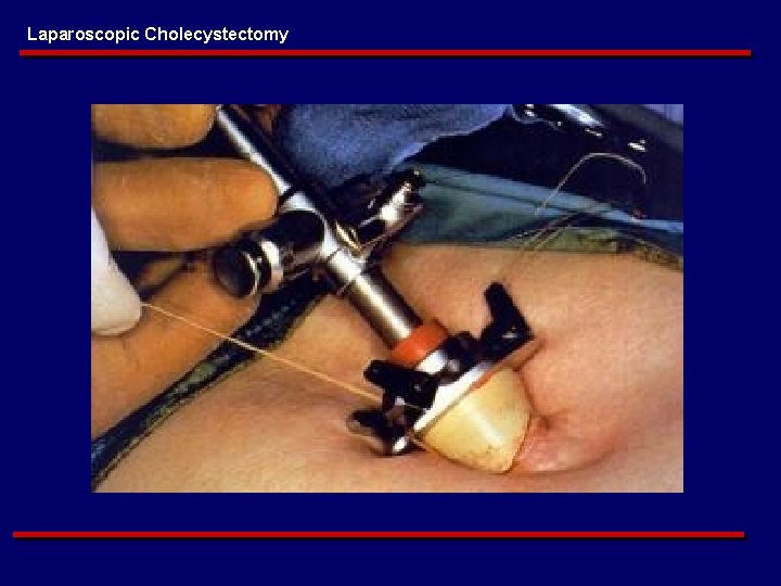 Laparoscopic Cholecystectomy 