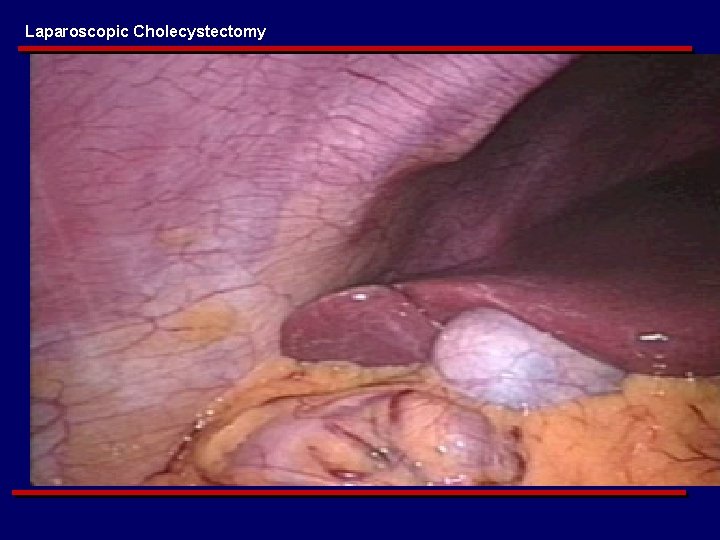 Laparoscopic Cholecystectomy 