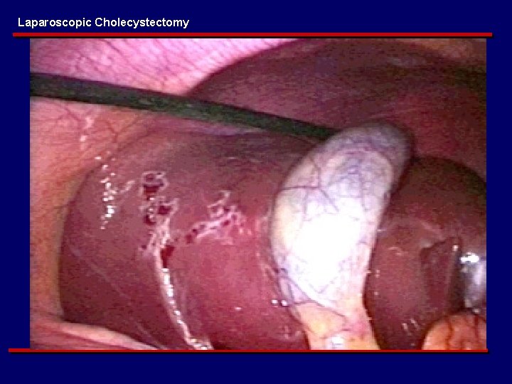 Laparoscopic Cholecystectomy 