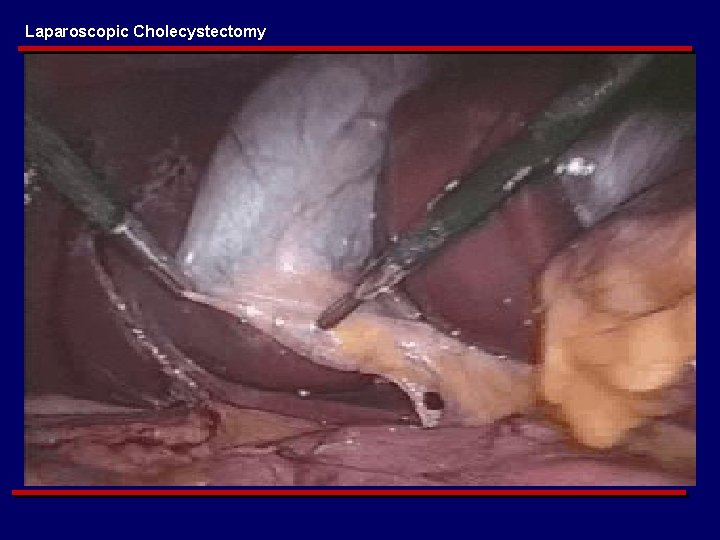 Laparoscopic Cholecystectomy 