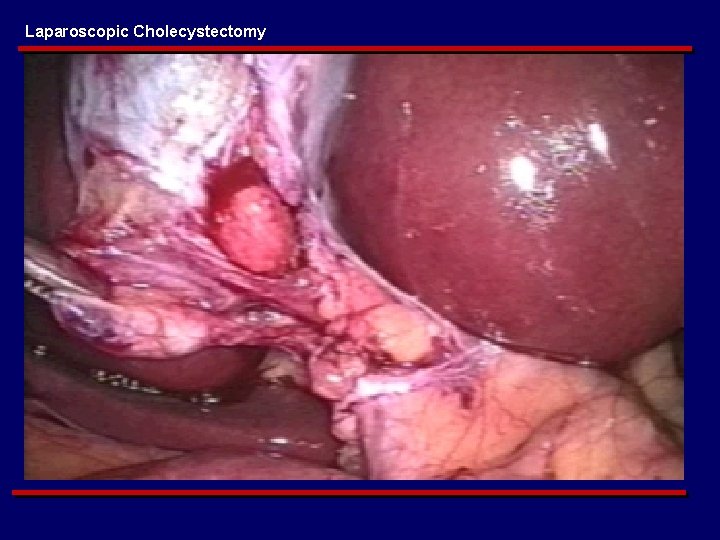 Laparoscopic Cholecystectomy 