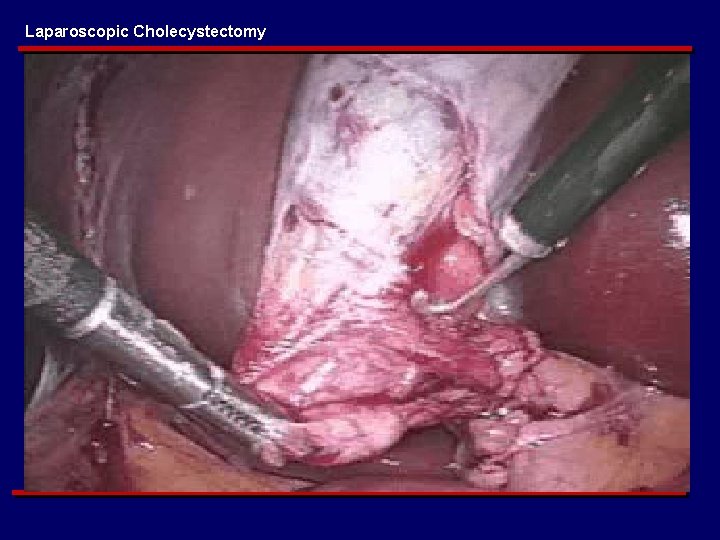 Laparoscopic Cholecystectomy 