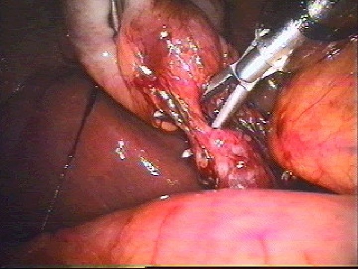 Laparoscopic Cholecystectomy 