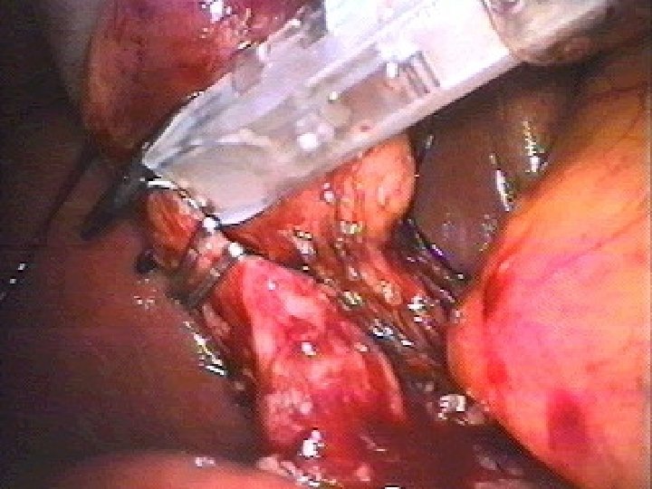 Laparoscopic Cholecystectomy 