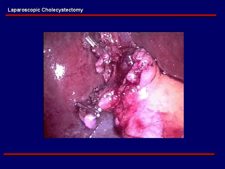 Laparoscopic Cholecystectomy 