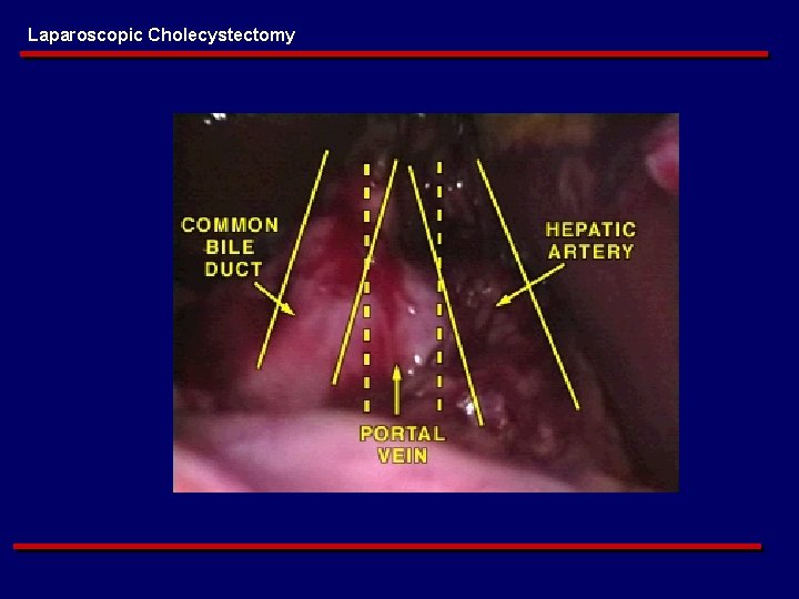 Laparoscopic Cholecystectomy 