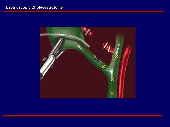 Laparoscopic Cholecystectomy 