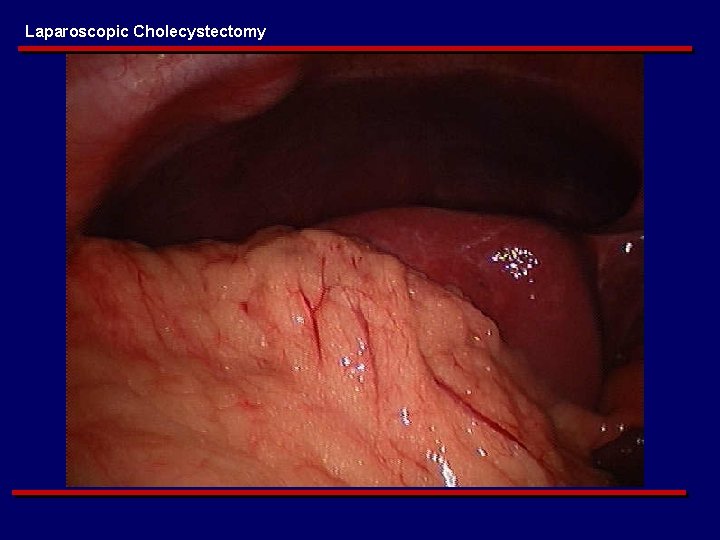 Laparoscopic Cholecystectomy 