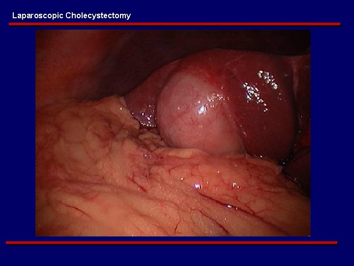 Laparoscopic Cholecystectomy 