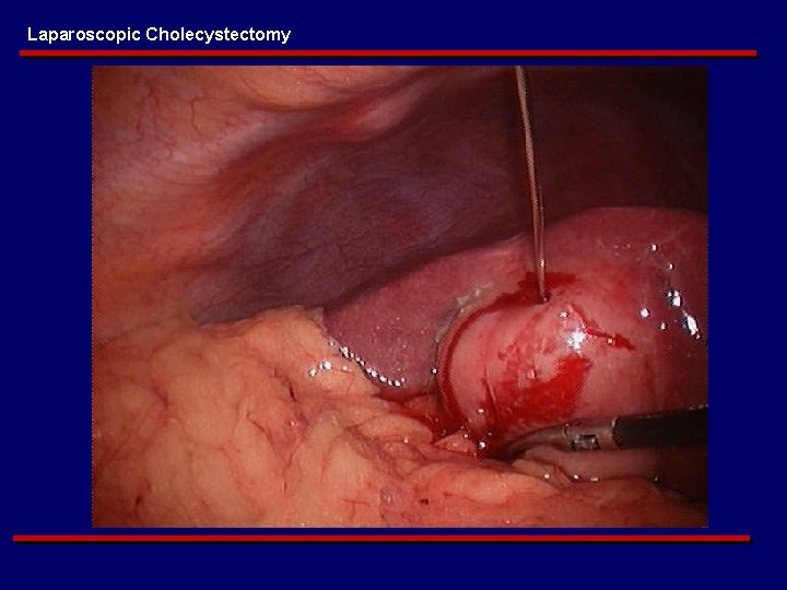 Laparoscopic Cholecystectomy 