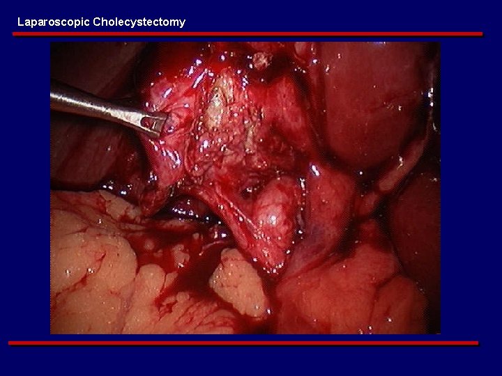 Laparoscopic Cholecystectomy 