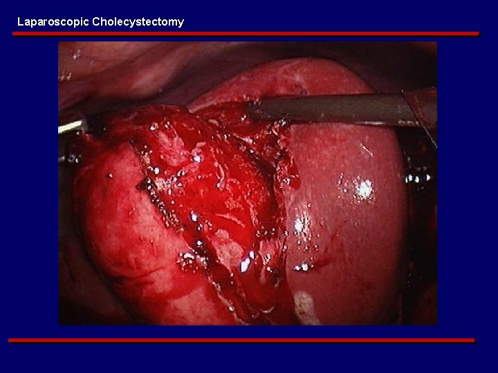 Laparoscopic Cholecystectomy 