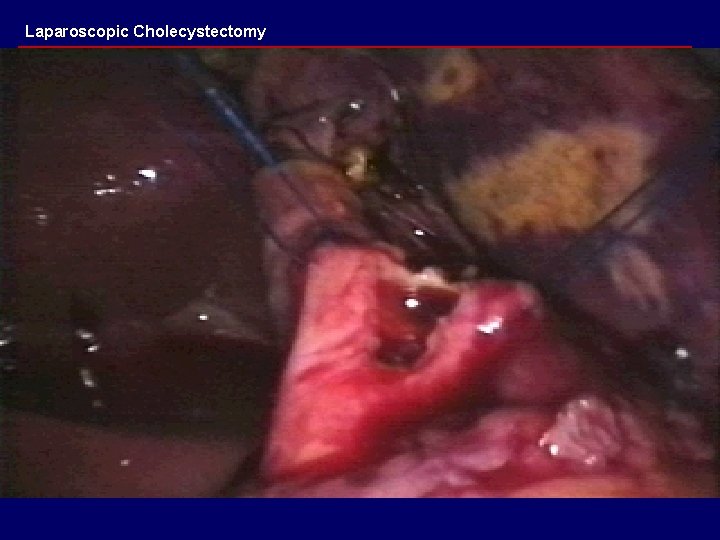 Laparoscopic Cholecystectomy 