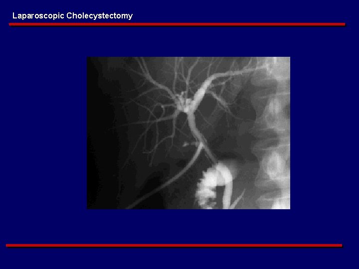 Laparoscopic Cholecystectomy 