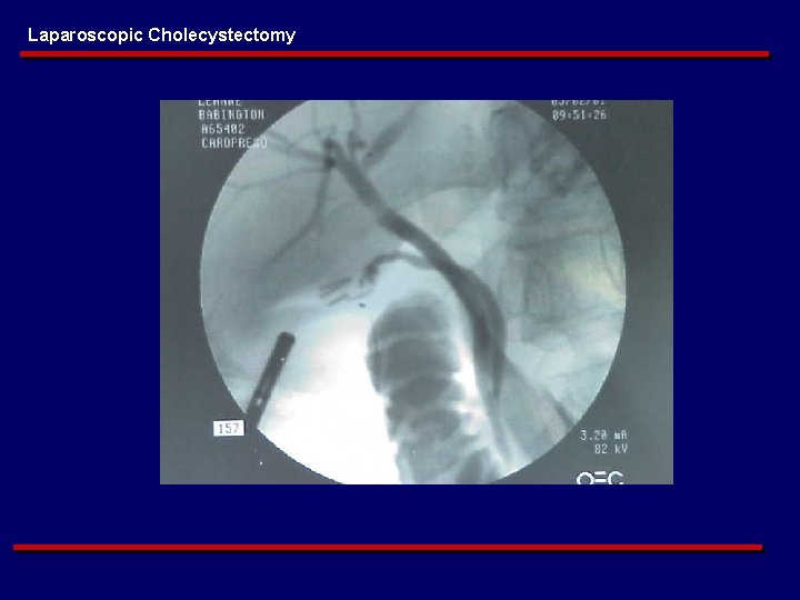 Laparoscopic Cholecystectomy 