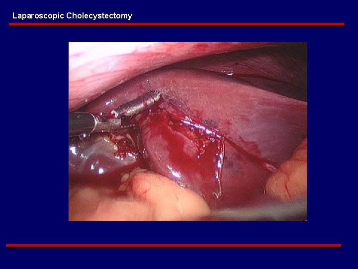 Laparoscopic Cholecystectomy 