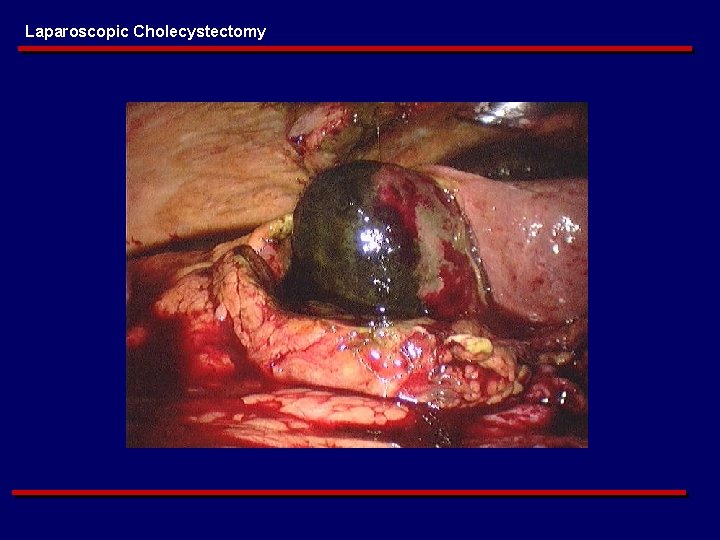 Laparoscopic Cholecystectomy 