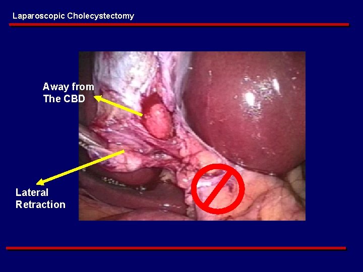 Laparoscopic Cholecystectomy Away from The CBD Lateral Retraction 