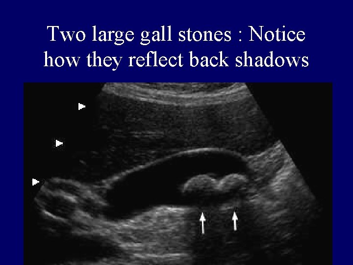 Two large gall stones : Notice how they reflect back shadows 