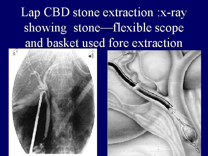 Lap CBD stone extraction : x-ray showing stone—flexible scope and basket used fore extraction